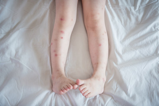 Mosquito bites sore and scar on child legs