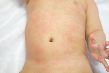 Close up skin rashes on newborn baby girls stomach