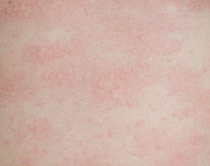 Rash in body
