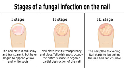Three stages of development of fungal infection on nail of the toe