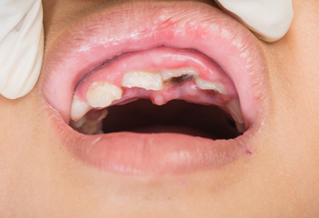 close up tooth loss in children