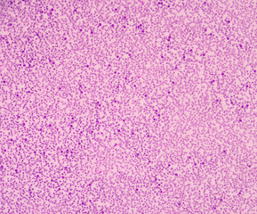 Sepsis or septicaemia is a life-threatening illness.