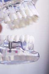 Fototapeta na wymiar Dentists dental teeth implant