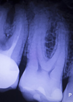 Tooth filling dental xray
