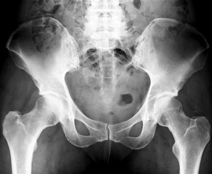 Pelvis X-Ray, human skeleton image 
