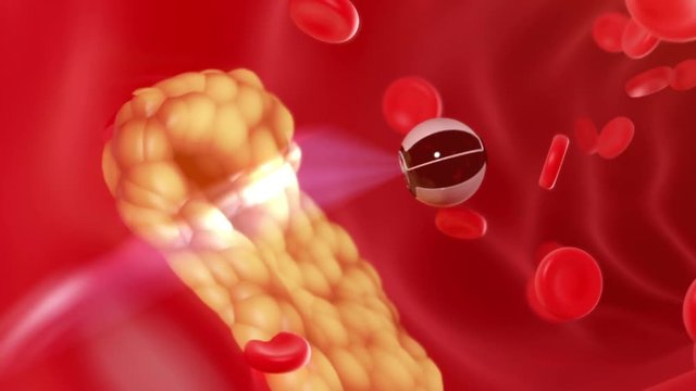 Nanobot finds and removes forming cholesterol plaque, abstract conceptual 3d animation. full HD 1080