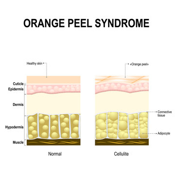 Cellulite or orange peel syndrome
