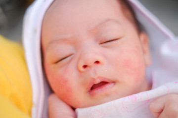 Portrait of a newborn baby close-up. face baby rashes