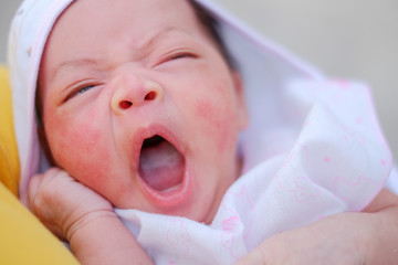 Portrait of a newborn baby close-up. face baby rashes