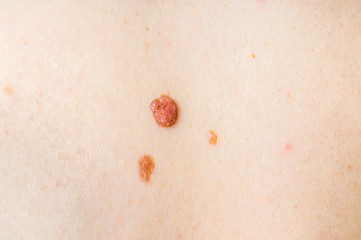 Woman with birthmark on her back