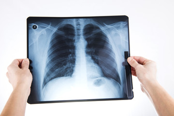X-ray of lungs doctor holding in hands