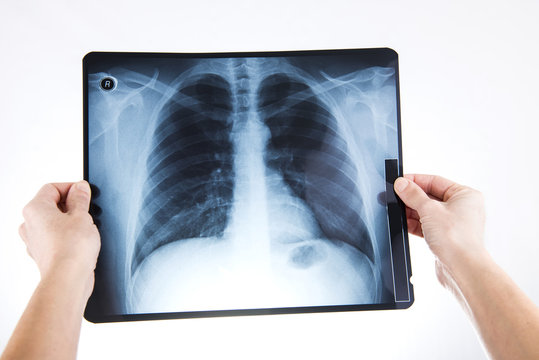 X-ray of lungs doctor holding in hands