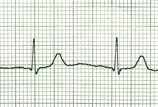 ECG Graph