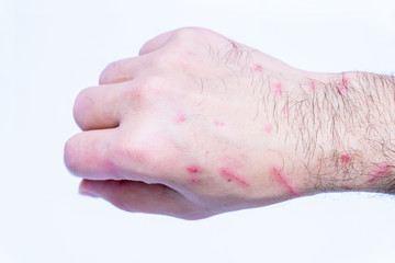 Fresh wound and blood from a bite cat