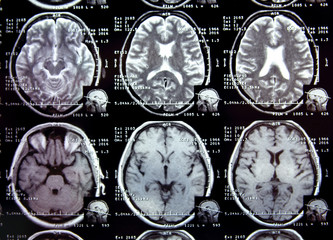 Closeup view of a MRI head scan with brain and skull on it. 