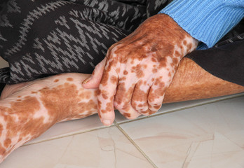 abnormal skin patient , hand and foot , mottled