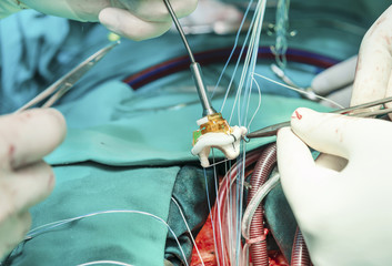 Placing stiches on artefitial heart valve