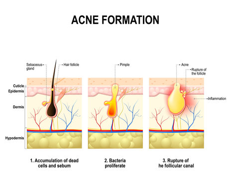 acne formation. human skin.