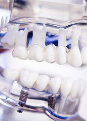 Fototapeta na wymiar Dentists dental teeth implant