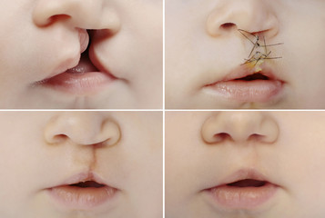 Close up on the lips of baby before and after lip and palate cleft  surgery. - obrazy, fototapety, plakaty