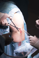 Surgical operation knee surgery