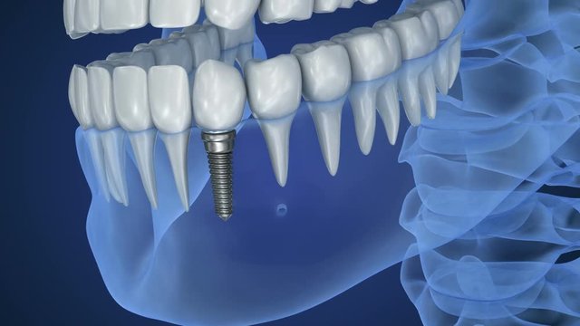 X-ray view of denture with implant. Xray view. Medically accurate 3D illustration 