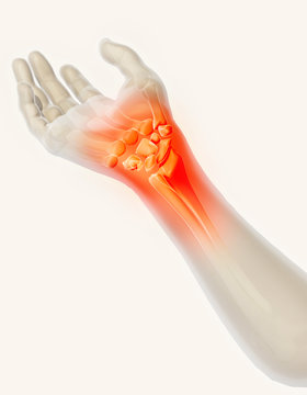 Wrist painful - skeleton x-ray.