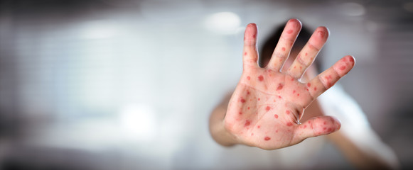 HFMD - Hand foot and mouth disease - Viral Diseases With Hand Infected
 - obrazy, fototapety, plakaty