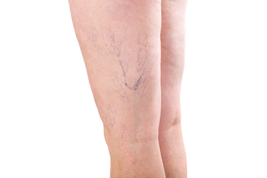legs with veins varicose spider