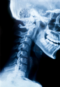 Röntgen Bild - X-Ray Schädel und Halswirbelsäule