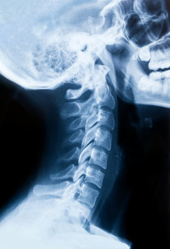 Röntgen Bild - X-Ray Schädel und Halswirbelsäule