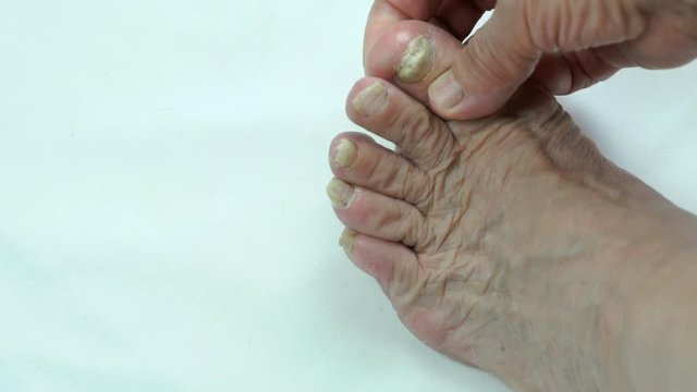 Toenails with fungal infection indoors