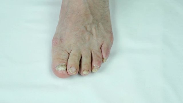 Onychomycosis with fungal nail infection of person's foot