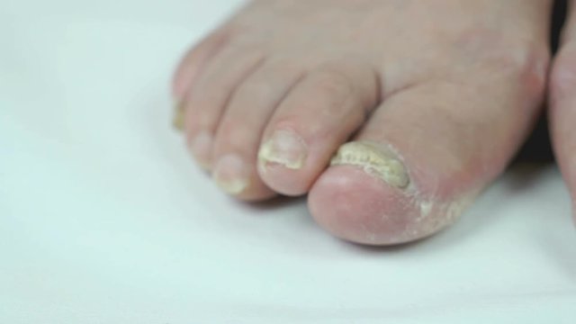 Fungal infections of feet of old woman close-up