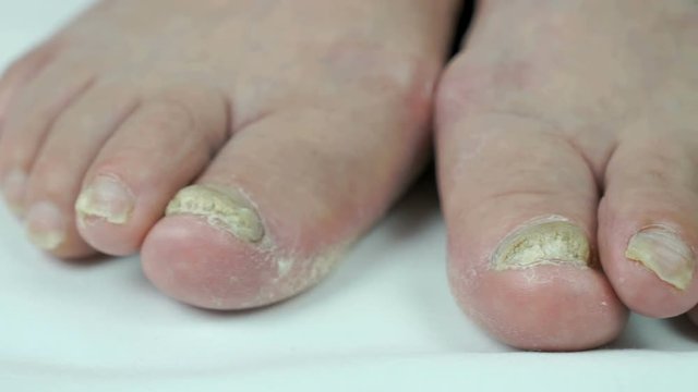 Fungus infection on nails of woman's foot close-up