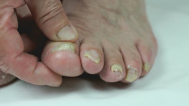 Aged sick woman's feet has fungal infections of toenails