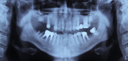 x-ray of teeth
