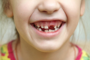 Childish mouth with missing milk teeth