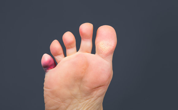 Foot Problems