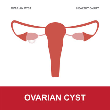vector illustration of ovarian cyst and healthy ovary