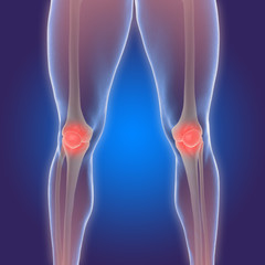 Arthritis im Knie