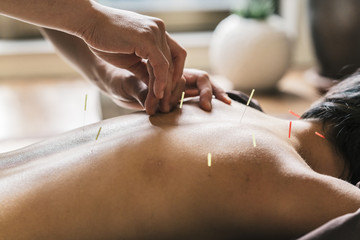 Therapist Giving acupuncture Treatment To a Japanese Woman - 133525230