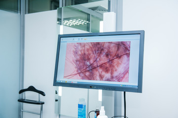 Close-up image of a mole on the monitor clinic equipment. Selective focus