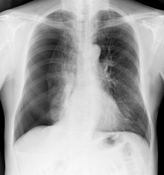 X-ray of the chest of a man with a pneumothorax