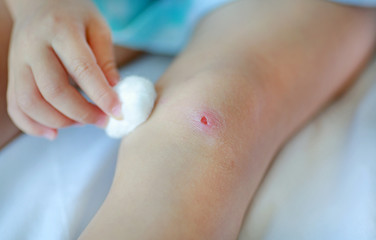 Close up wound on child knee. Mother dressing child's knee.
