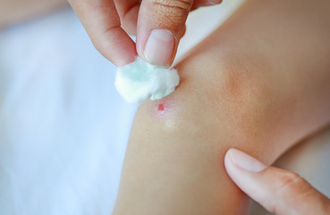 Close up wound on child knee. Mother dressing child's knee.