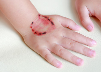 Sticker wound and blood from a bite human teeth on child hand, Dress up tattoos, Halloween concept.
