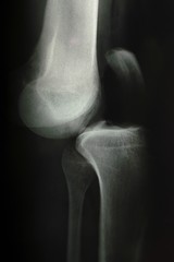 X-ray, bone dislocation after accident (model-released)