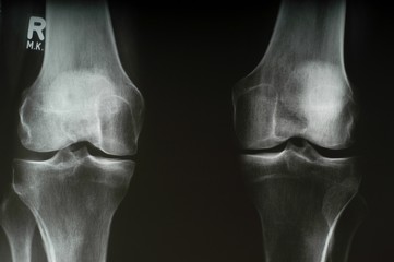 X-ray of a woman, knee of a woman, 40-50 years, arthrosis (model