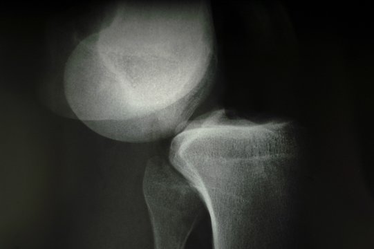 X-ray, bone dislocation after accident (model-released)